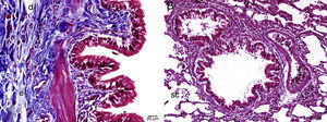Histopathological examination by light microscopy of lung tissue in MI group stained by Masson's trichrome A: f: fibrosis, e: edema, d: degenerating cells, B: sc: regular appearance in saccus alveolaris, MI: methotrexate+infliximab applied group.