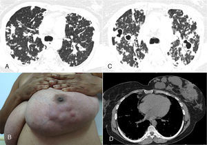 High-resolution computed tomography of the upper lobes (A) revealed small confluent nodules in both lungs. Physical examination of the left breast (B) showed palpable and visible lumps in the inner quadrants. The right breast was normal. Follow-up computed tomography at the same level (C) demonstrated worsening of the pulmonary lesions, with the appearance of multiple cavitating masses in the upper regions of both lungs. A chest computed tomography with mediastinal window setting showed the lesions in the left breast (D).