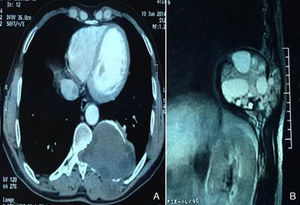 (A) Chest computed tomography showing a left multivesicular hydatid cyst in the costo-vertebral area involving the 8th and 9th ribs and the corresponding D11–D12 vertebrae, with costal lysis and spinal extension and no signs of medullar compression. (B) Hydatid cyst on chest T2-weighted coronal magnetic resonance imaging showing solid matrix with numerous daughter cysts in the mass.