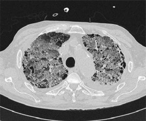 Chest computed tomography showing lung window: bilateral ground glass infiltrates consistent with acute respiratory distress, not ruling out organizing pneumonia. Cystic areas corresponding to paraseptal and centrolobular emphysema.