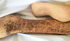 Photograph of the posteromedial aspect of the patient's right leg. Typical ichthyosis lesions are observed: dry, rough skin, with hyperpigmented, brownish scales, with polygonal, free, irregular margins.