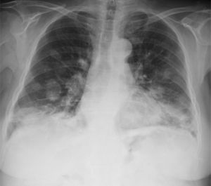 Chest X-ray, showing a chance finding of images of bilateral nodules resembling a “balloon release”, predominantly in the mid and lower fields.