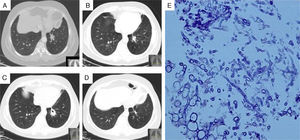 (A) Chest computed tomography (CT), showing a nodule in the left lower lobe; (B) chest CT 2 months after starting treatment with voriconazole, showing the nodule reduced in size; (C) chest CT during itraconazole treatment, showing nodule growth with cavities; (D) chest CT performed after 7 months of voriconazole treatment, showing residual fibrotic changes; (E) nodule biopsy, showing infiltration of mononuclear cells and fungal structures identified as Aspergillus fumigatus.