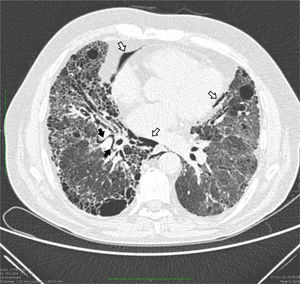 Chest computed tomography showing a thin curved line of gas surrounding the bronchovascular bundles of the right lower lobe, associated with interstitial emphysema (black arrows); extensive emphysematous changes were also observed in the mediastinum close to the heart and descending thoracic artery (pneumomediastinum: white arrows).