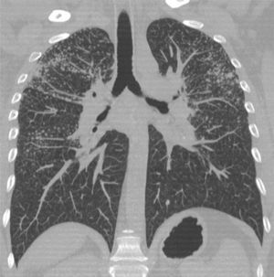 Case 2: coronal plane multiplanar reconstruction.
