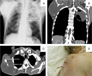 A–chest X-ray (posteroanterior incidence): mass with dense soft tissues in the right scapula, and a cavitation with fluid level in the upper half of the left lung. B and C–chest CT (coronal and axial planes): bulky heterogeneous mass of about 110×94mm invading the right scapula and the adjacent muscles, with periosteal reaction of the scapula, and heterogeneous nodular formation in the apical posterior segment of the left upper lobe, with central cavitation, of about 88×80mm, with invasion of the mediastinal fat and the chest wall. D–photography of suprascapular right mass after surgical biopsy.