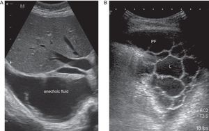 (A) Anechoic pleural effusion. (B) Pleural effusion with multiple septa and loculations. L, loculation; PF, pleural fluid; S, septum.