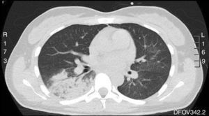 Chest computed tomography showing right lower lobe consolidation.