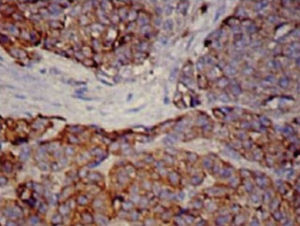 Histology slide at 30× amplification with chromogranin immune staining, showing tumor cell nests separated by fibrovascular tracts.