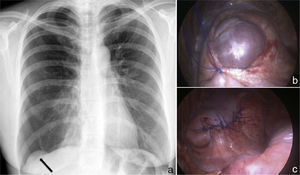 (a) Posterolateral chest X-ray showing complete right pneumothorax with no mediastinal shift. Diaphragmatic lobulation is also seen (arrow). (b) Right diaphragmatic herniation on video-assisted thoracoscopy, showing the hepatic dome. (c) Herniation closed by separate monofilament sutures.