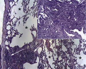 Pathology sample with hematoxylin and eosin staining (10× magnification) showing granulomas (white arrow) and small vesicles (*). Activated lymphocytes and giant inflammatory cells were observed.