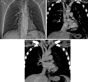 (A) Chest X-ray showing subtle widening of the paratracheal stripe (arrow). Neither parenchymal opacities nor pleural effusion is observed. (B) Coronal maximum intensity projection (MIP) reconstruction confirming a soft tissue mass surrounding the circumference of the SVC, causing severe stenosis of its lumen (arrows). Coronal MIP reconstruction carried out 4 weeks after starting treatment, showing improvement in SVC stenosis (asterisk).