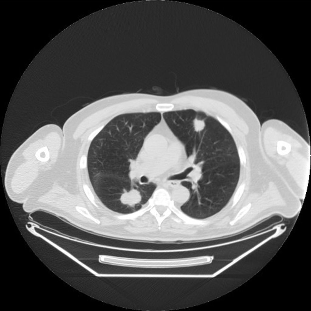 Adenoid Cystic Carcinoma of the Lung. A Case Report | Archivos de ...