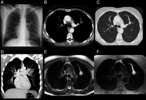 (A) Posterior–anterior chest X-ray. (B and C) Chest computed tomography with intravenous contrast medium, axial slice at the level of the aortopulmonary window in a mediastinum and lung window, respectively. (D) Multidetector CT coronal reconstruction in maximum intensity projection (MIP) mediastinum window. (E and F) Chest magnetic resonance image, axial slices at level of aortopulmonary window. T2 and T1-weighted axial slices with fat suppression.