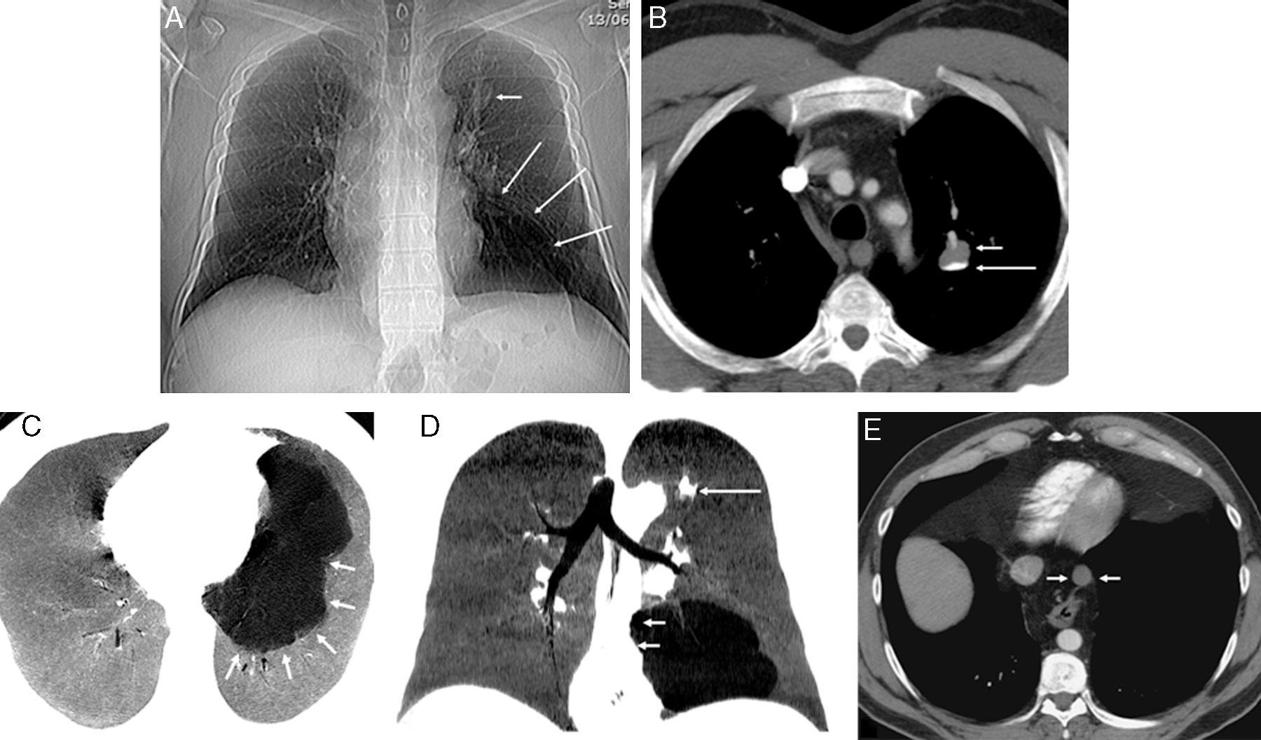 Association of Three Developmental Lung Anomalies in an Adult ...