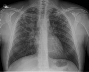 Chest X-ray of case 1. Bilateral cavitating infiltrate in right upper lobe.