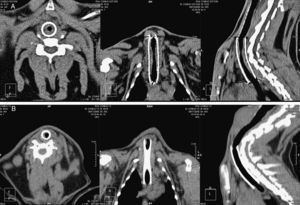 (A) Axial, coronal and sagittal views of stenosis in the segments in contact with the stent in a rabbit from the DES group at day 30. (B) Axial, coronal, and sagittal views of a suspected granuloma, located in segment 0, in a rabbit from the ST group at day 30.