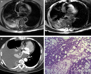 (a) Chest magnetic resonance imaging, T2-weighted axial sequence showing heterogeneous lesion with hyperintense foci due to fluid cavities or fat (*) and hypointense linear images, due to septa or vessels (arrows); (b) Spoiled gradient-echo T1-weighted axial sequence with fat suppression and early-phase paramagnetic contrast medium (intravenous gadolinium): heterogeneous mass with enhancement of some of the serpiginous images (arrow); (c) computed tomography with intravenous contrast medium: heterogeneous lobulated mass, showing reticular and linear enhancement, with small hypodense foci (arrow), compatible with fat; and (d) solid tumor consisting of mature adipose tissue associated with a network of thin-walled, anastomated blood vessels. Red blood cells are seen in most of the vessels (hematoxylin & eosin ×100).