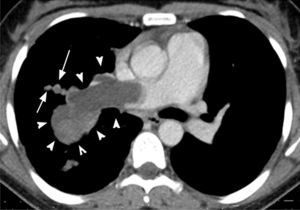 Axial contrast-enhanced chest computed tomography of a 35-year-old woman with dyspnea, chest pain, and hemoptysis over several months. An extensive irregular filling defect with inhomogeneous attenuation occupies the right main pulmonary artery and extends into the pulmonary artery branches, with increased vascular diameters (arrowheads). Note also the beaded aspect of a peripheral artery (arrows).