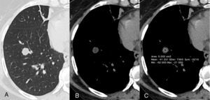 Axial CT images with lung (A) and mediastinal (B) windows showing a well-defined hypodense nodule measuring 13mm in diameter in the right lower lobe. The nodule has fat density (mean density, −41HU) (C).