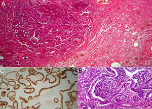 (A) Adenocarcinomatous proliferation of lung parenchyma (Gx10). (B) Pathological view showing Lieberkuhnien glands (Gx20). (C) Pathological view showing positive anti-CK7 (Gx20).