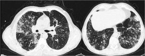 Chest computed tomography scan showing areas of subpleural ground-glass opacities, mainly in the upper lobes, and areas of interlobular septal thickening, mainly in the lower lobes.