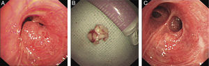 Bronchoscopy image of a moruloid, highly vascularized, pink tumor (A), resected to reveal a hard popcorn-like mass (B), unobstructed left upper bronchus and normal bronchial mucosa at the site of resection (C).