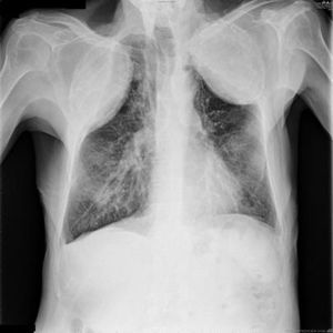 Standard posteroanterior chest X-ray. Increase in density in both lung apices, caused by bilateral oleothorax used to treat pulmonary tuberculosis.