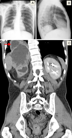 (A and B) Chest X-ray (posteroanterior and lateral aspects, respectively) revealing a rounded opacity in the right lung base. (C) Thoracoabdominal CT (coronal plane) showing a large abdominal mass of about 13cm×11cm×8.3cm, apparently originating in the right kidney, invading the right lobe of the liver, the diaphragm and the lower lobe of the right lung (red arrow).