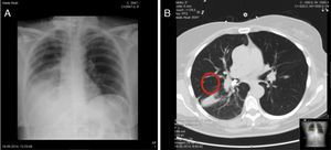 Chest X-ray (A) showing atelectasis and pulmonary infiltrates in right base consistent with a tooth; CT scan (B) showing opacity in the right lower lobe and 13mm endobronchial foreign body.