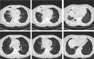 Upper panel: computed tomography (CT) images of the chest obtained at the time of presentation with pneumothorax and pleural effusion. Consolidation is shown in the right middle lobe (first and second panel), and air-fluid levels are shown in the right pleural space (third panel). Tree-in-bud opacification is shown in both lungs. Lower panel: CT images obtained 3 months following commencement of treatment for NTM disease. There is resolution of the right sided pleural effusion and pneumothorax, with re-expansion of the lung and improvement in consolidation of the right middle lobe.