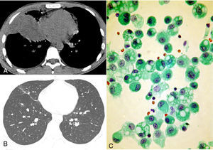 (A) Computed tomography with the mediastinal window setting shows a mass in the right lower lobe, adjacent to the pleural surface. (B) Follow-up computed tomography with the lung window setting demonstrated reabsorption of the mass, with residual scarring. (C) Alveolar macrophages recovered by bronchoalveolar lavage. The cytoplasm is full of large rounded vacuoles that displace nuclei to the periphery.