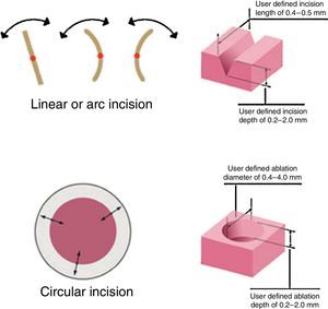 AcuBlade can perform different types of incision (straight, curved, or disk ablation) of varying length and depth, according to the shape of the lesion.