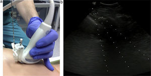 A needle guide (a) was attached to the US transducer during needle biopsy with real-time imaging (b) to ensure greater accuracy and reduce the risk of injury to adjacent tissue.