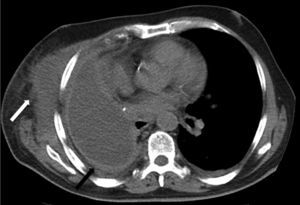 Pleural empyema of the remaining cavity (black arrow) associated with an abscess contiguous with the chest wall (white arrow).