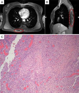 Axial (A) and sagittal (B) T1-weighted magnetic resonance imaging of the chest, revealing an extensive space-occupying lesion in the back muscles, with contrast enhancement of the wall. (C) Histopathological examination revealing an extensive mixed inflammatory infiltrate with numerous histiocytes and areas with epithelioid non-necrotising granulomas.