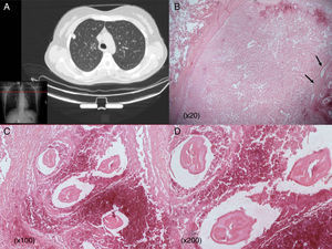 (A) Chest CT scan showing an apparently malignant solitary nodule in the right upper lobe abutting the pleura. (B) Well-defined necrotic pulmonary nodule invading normal lung parenchyma. Worms in necrotic tissue (arrows) (20×). (C and D) Typical dirofilariasis worms (D. immitis) embedded in necrotic material (C: hematoxylin and eosin staining 100×; D: hematoxylin and eosin staining 200×).