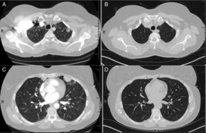 CT of chest (A), initial CT demonstrating left upper lobe nodule with cavitation (B), nine month follow-up CT with resolution of left upper lobe nodule, (C) initial CT demonstrating peripheral nodule in the lingual and (D) nine month follow-up CT with resolution of peripheral nodule in the lingual.