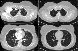 CT of chest (A), initial CT demonstrating left upper lobe nodule with cavitation (B), nine month follow-up CT with resolution of left upper lobe nodule, (C) initial CT demonstrating peripheral nodule in the lingual and (D) nine month follow-up CT with resolution of peripheral nodule in the lingual.