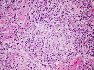 Histopathological characteristics in farmer's lung disease. Loose, non-necrotizing granulomas formed by histiocytic aggregates and abundant lymphoplasmacytic infiltrate (hematoxylin-eosin 40×).