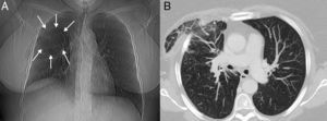 (A) Chest X-ray showing a rounded radiolucent area in the right upper lung field (arrows). (B) Chest computed axial tomography image (pulmonary parenchymal window) showing areas of ground glass attenuation and interstitial thickening in the herniated pulmonary parenchyma, consistent with areas of venous congestion and edema.