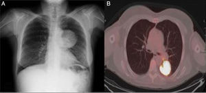 (A) Chest X-ray: left paracardiac mass. (B) Positron emission tomography; left lower mass with marked increase in glucidic metabolism, in contact with the posterior pleura, paravertebral space and oblique fissure.