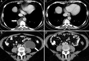 Chest computed axial tomography (CAT) (A) showing a right paravertebral cystic lesion 3.2×1.9cm, consistent with retrocrural lymphangioleiomyoma. Abdominal CAT (B) showing tumor 6.8×3.9×5.1cm of retroperitoneal cystic appearance, located in the left para-aortic region, extending to the pelvis, consistent with abdominal lymphangioleiomyoma. Chest-abdominal CAT one year later (C and D) showing practically complete resolution of lesions.