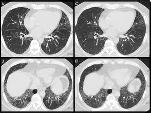 (A and B) High-resolution computed tomography showing raised diaphragm, ground glass opacities, interlobular thickening, and traction bronchiectasis predominantly in the lower lobes, a pattern compatible with non-specific interstitial pneumonia. (C and D) CT scans after rituximab treatment showing improvement in ground glass opacities.