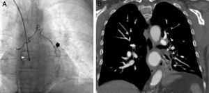 (A) Coronary catheterization. Right coronary artery (white arrow). Abnormal artery extending toward the left lower lobe base (black arrow). (B) Chest computed tomography angiography – coronal reconstruction. Small arrows indicate the collapsed left lower lobe. The black arrow indicates the drainage vein in the left atrium.