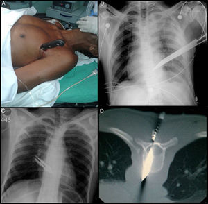 (A) Knife impaled in the left thorax. (B) Chest radiograph. The blade of the knife can be seen above the cardiac silhouette and the left hemothorax. (C) Knife impaled in the posterior thorax. No hemothorax or pneumothorax seen on portable chest radiograph. (D) CT of spine in prone position.