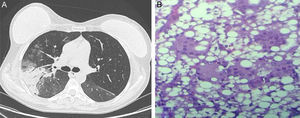 (A) Chest computed axial tomography slice, showing areas of parenchymal consolidation with air bronchogram and ground glass opacities in the upper right lobe. (B) Histology study (×40) of the lung biopsy showing multinucleated macrophages with foreign body vacuoles (silicone).