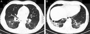 Chest computed tomography showed: (A) Bilateral nodular lesions and ground glass densities, mainly affecting the lower lobes. (B) Area of parenchymal consolidation and associated pleural effusion in left lower lobe.