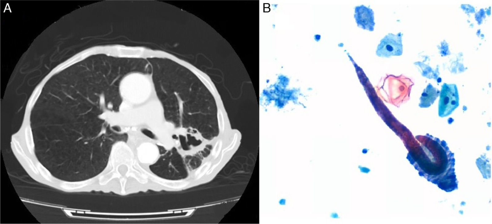 Pulmonary Strongyloides stercoralis Infection | Archivos de ...