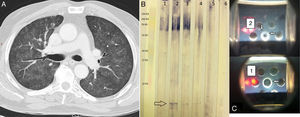 (A) Chest HRCT. Pulmonary parenchymal window shows a ground glass pattern and small centrilobular nodules in both lung fields. (B) Western blot. Lane 1 shows the serum of an asymptomatic individual receiving BCG; lanes 2, 3, and 4 show the index case after 3, 7, and 51 of corticosteroid therapy. Lane 5 shows the serum of an individual with a history of tuberculosis, and lane 6 is that of a healthy control. The arrow indicates a single band (specific anti-BCG antibodies). (C) Double immunodiffusion of sera 1 and 2. Arrows indicate precipitation bands.